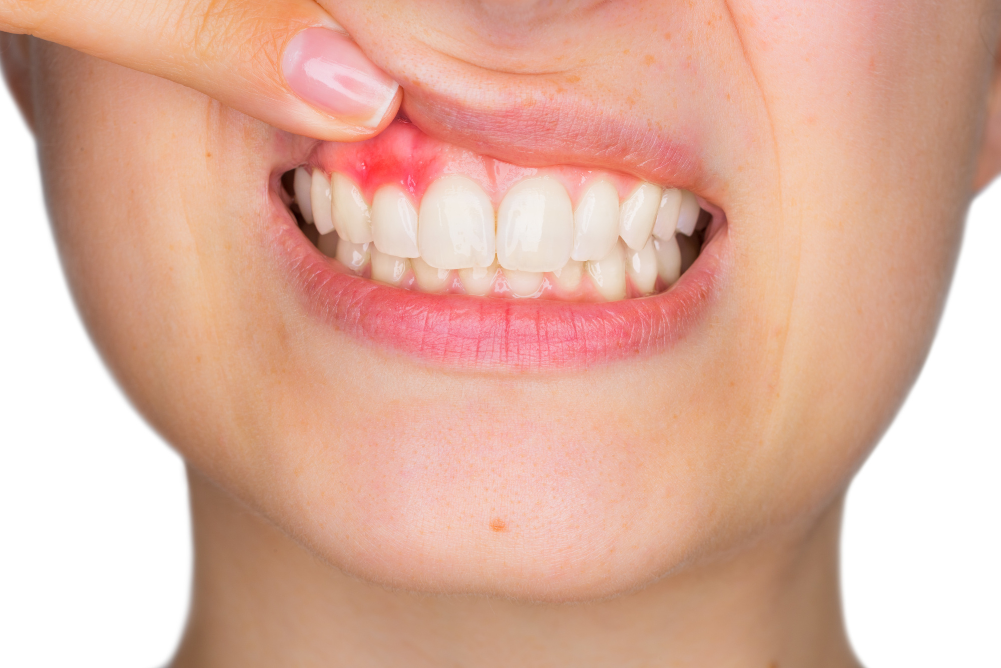 Bleeding Gums Treatment
