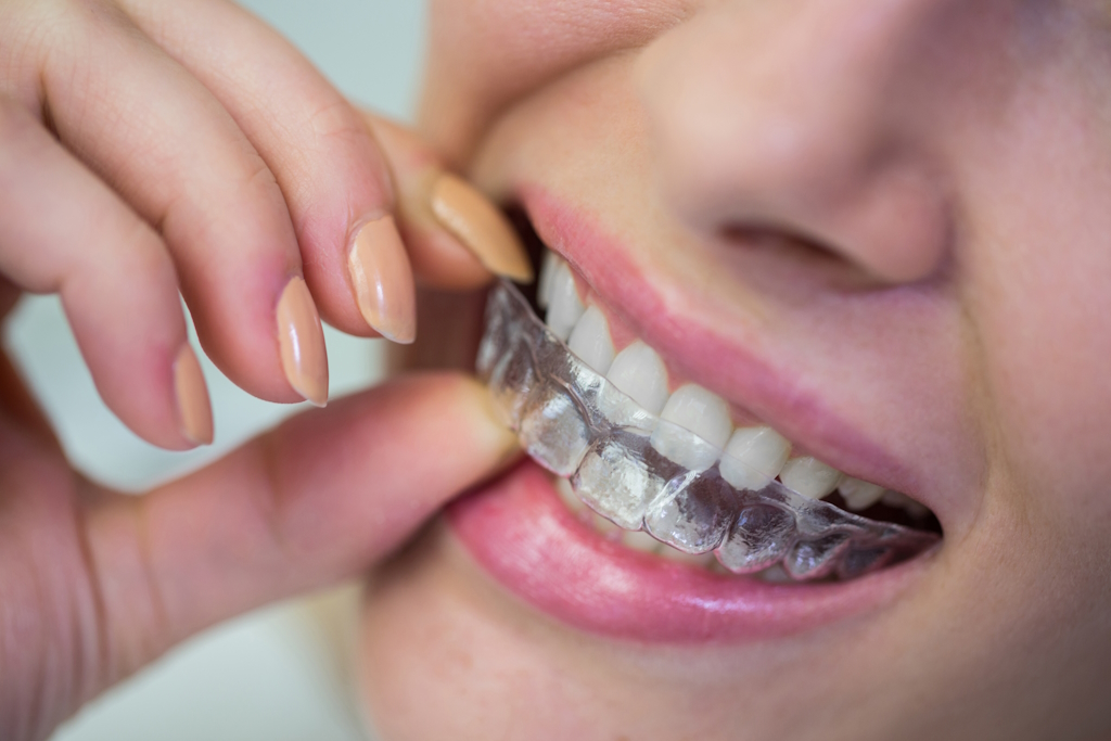 Invisalign & Braces